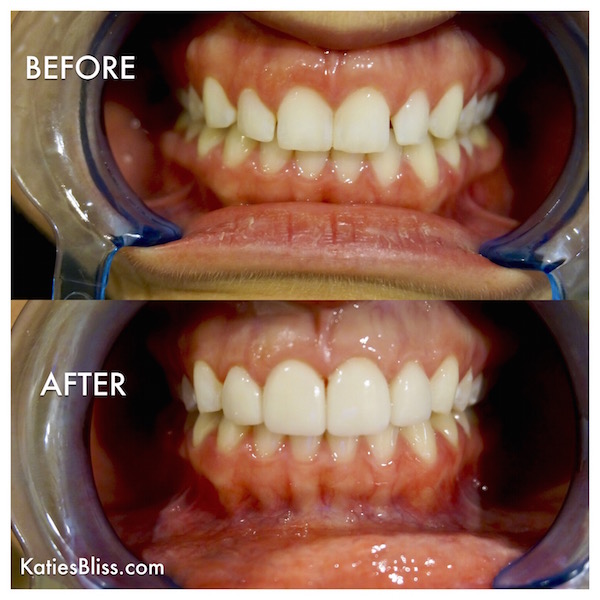 Porcelain Veneers Before and After